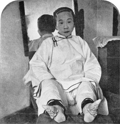 Một phụ nữ Trung Quốc với đôi chân biến dạng ( Ảnh minh họa)