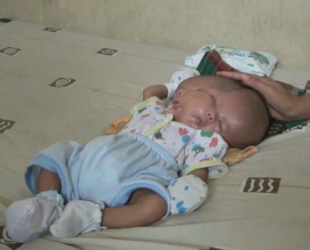
Cậu bé Gilang được sinh ra với 2 khuôn mặt và 2 bộ não trên cùng một cơ thể
