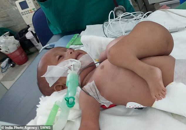Xót xa trước hình ảnh bé gái 7 tháng tuổi vừa sinh ra đã mang dị tật ghê rợn: mọc thêm tay chân