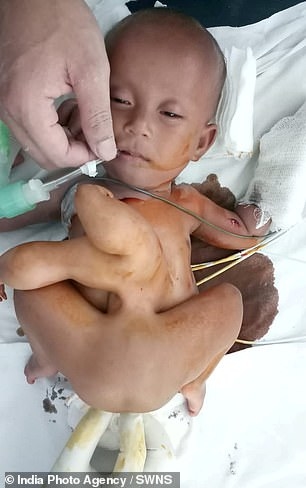 Xót xa trước hình ảnh bé gái 7 tháng tuổi vừa sinh ra đã mang dị tật ghê rợn: mọc thêm tay chân