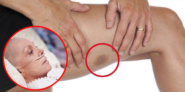 Đừng chủ quan nếu bạn hay có những vết bầm không rõ lý do, đó là dấu hiệu của nhiều bệnh nguy hiểm Đừng chủ quan nếu bạn hay có những vết bầm không rõ lý do, đó là dấu hiệu của nhiều bệnh nguy hiểm