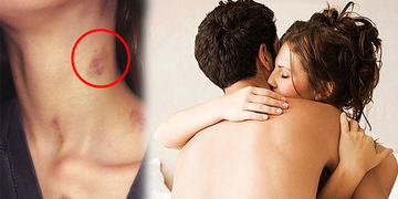 Cảnh giác với "hickey": Dấu hôn trên cổ và nguy cơ người yêu bạn tử vong nếu cứ bất chấp để "phê" Cảnh giác với "hickey": Dấu hôn trên cổ và nguy cơ người yêu bạn tử vong nếu cứ bất chấp để "phê"