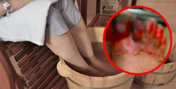 Góc Cảnh Giác: Hoại tử các ngón chân và lở loét do ngâm chân trong nước nóng Góc Cảnh Giác: Hoại tử các ngón chân và lở loét do ngâm chân trong nước nóng
