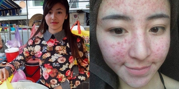 Lộ ảnh “hot girl bánh tráng trộn” mặt mụn chi chít, nhan sắc xấu đến mức không thể nhận ra Lộ ảnh “hot girl bánh tráng trộn” mặt mụn chi chít, nhan sắc xấu đến mức không thể nhận ra