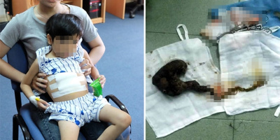 TP.HCM: Cấp cứu bé gái 7 tuổi nguy kịch vì thích ăn tóc thay cơm