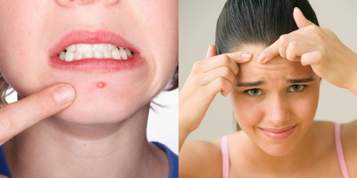 Đừng chủ quan, vị trí mụn trên mặt cảnh báo rất nhiều vấn đề về sức khỏe đấy!
