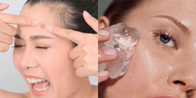 7 mẹo hữu hiệu nhất để nặn mụn mà không sẹo, không thâm