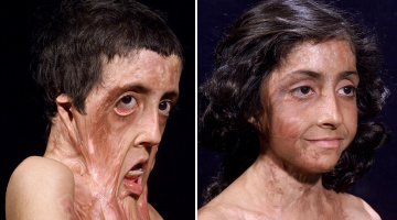 Cô bé có gương mặt biến dạng kinh hoàng vì bỏng nặng "lột xác" sau 12 lần phẫu thuật