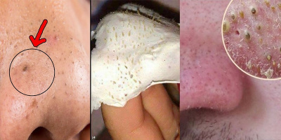 Màn nặn mụn đầu đen khiến mọi tín đồ nặn mụn cũng phải sởn da gà