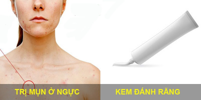 500 chị em bị mụn mọc ở ngực đáng ghét hãy đọc ngay bài viết này
