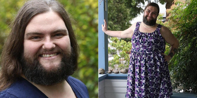 Cô gái 39 tuổi mắc căn bệnh quái lạ: mọc râu và lông ngực rậm rạp như đàn ông