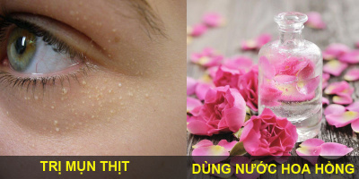 Mụn thịt "cứng đầu" là gì, và cách để xử lý đám mụn đáng ghét chỉ trong "một nốt nhạc"?