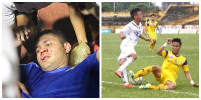 Thiago gãy sống mũi và những chấn thương kinh hoàng bóng đá Việt