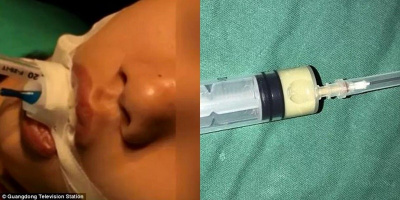 Bé gái phát hiện khối áp xe trong não vì nặn mụn đầu đen