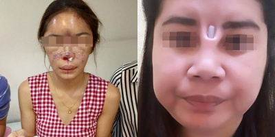 Góc kinh hoàng: Những hậu quả "đáng sợ" khi nâng mũi, chị em hãy thật cẩn thận trước khi quyết định