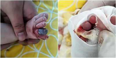 Bé trai 2 tháng tuổi có nguy cơ bị cắt bỏ ngón chân, chỉ vì một... sợi tóc của mẹ