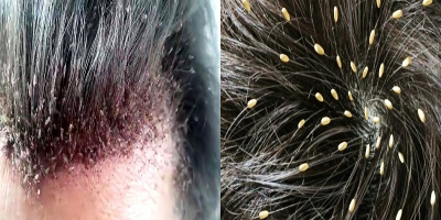 Đừng tưởng ở thành phố mà không có chấy rận trên đầu, coi chừng bạn đang bị mà không biết đấy