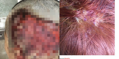 Làm đẹp đón tết: Bỏ gần 5,4 triệu làm tóc, cô gái "tá hỏa" khi nhận lại mái đầu bị hỏng và chảy máu