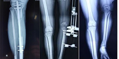Ca phẫu thuật kéo dài chân kỷ lục ở Việt Nam