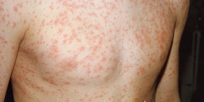 Dịch bệnh giết chết hàng trăm nghìn người mỗi năm gia tăng ở Hà Nội