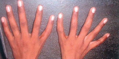 Kì lạ hội chứng "tay người ngoài hành tinh" khiến ngón cái... biến thành ngón trỏ