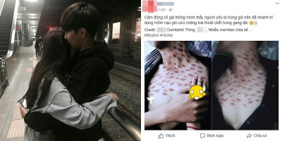 “Đánh dấu chủ quyền” người yêu, đến nỗi chàng trai bầm dập như đi cạo gió thế này thì quả là tài!