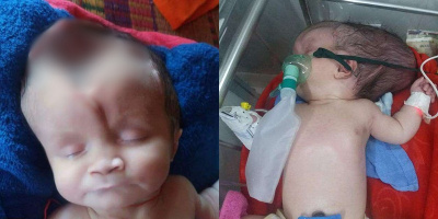 Bé 2 tháng tuổi sinh ra bị mất hộp sọ và câu chuyện cứu chữa con của bố mẹ lấy nước mắt triệu người