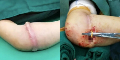 Bé gái suýt mất mạng vì đeo vòng thun liên tục khiến nó “ăn” sâu vào da thịt