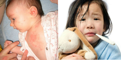 Các dấu hiệu để nhận biết căn bệnh sốt phát ban ở trẻ nhỏ giúp điều trị kịp thời, tránh biến chứng