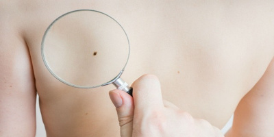 Những dấu hiệu ung thư tiết lộ qua nốt ruồi mà bạn không thể bỏ qua