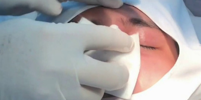 Một phụ nữ bị hoại tử, có nguy cơ mù mắt sau khi tiêm filler nâng mũi