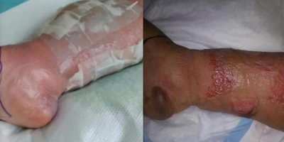 Cảnh báo: Nguy cơ mất chân vì nhiễm trùng nặng sau khi đi làm móng