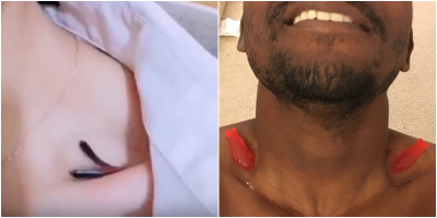 Sau tiền xu, giới trẻ lại đua nhau thực hiện trào lưu thả cá vào xương quai xanh để "đọ" dáng chuẩn