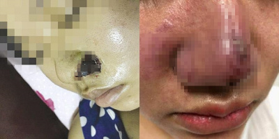 Hà Nội: Một người phụ nữ bị méo mặt, biến dạng, ổ mủ trong mũi khi tiêm filler để làm đẹp