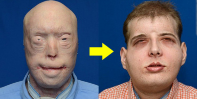 Người đàn ông mang khuôn mặt dị dạng suốt 14 năm trời, chịu hơn 70 ca phẫu thuật để được làm người