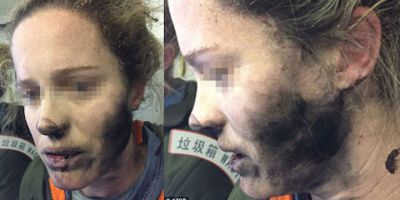 Góc Cảnh Giác: Đeo tai nghe khi đi máy bay khiến cô gái bị cháy tóc, bỏng mặt