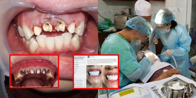 GÓC CẢNH GIÁC: Trào lưu bọc răng, phủ răng sứ và cạm bẫy phía sau những "nụ cười công nghiệp"