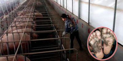 Không mang giày chơi trong chuồng lợn, cô bé 10 tuổi mắc căn bệnh lạ đáng sợ