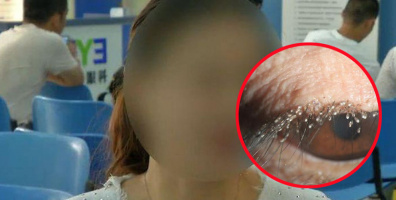 Cô gái phát hiện có cả trăm con bọ ve trên mi mắt vì lười tẩy trang