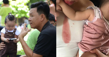 Bé gái 14 tháng tuổi nôn ra máu sau khi được bố hút thuốc lá ôm hôn