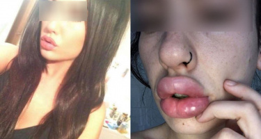Cô gái suýt bị hoại tử môi vì "cuồng" tiêm filler giá rẻ