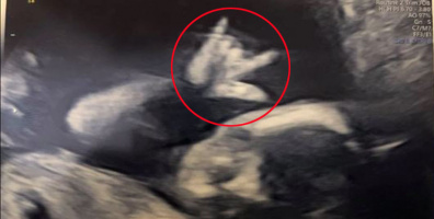 Bác sĩ xin chụp ảnh khi thấy thai nhi giơ tay biểu tượng rock cực ngầu