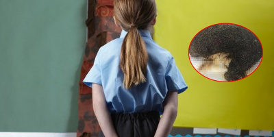 Phát hiện búi tóc kích thước 20cm trong dạ dày của bé gái 11 tuổi