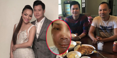 Quang Dũng mong ông xã ở cạnh Hồng Ngọc khi điều trị vết bỏng