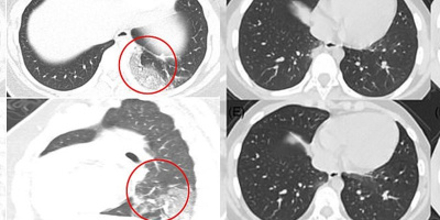 Hình ảnh phổi của trẻ em nhiễm Covid-19: Bị tràn dịch, sưng tấy rộng