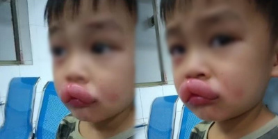 Vừa thương vừa buồn cười với cậu bé dị ứng nho, sưng vều miệng