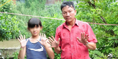 Kỳ lạ gia đình "dị biệt" cả 3 thế hệ đều có tới 24 ngón tay, chân