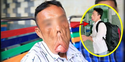 "Bắt bệnh" cho chàng trai có khuôn mặt biến dạng suốt 15 năm
