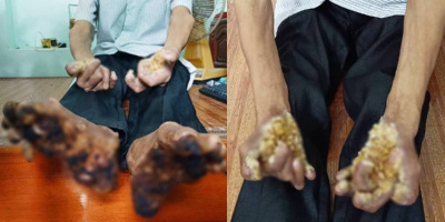 Bệnh "người cây" biến tay chân thành gỗ từng xuất hiện ở Việt Nam