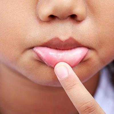 "Nằm lòng" chứng bệnh nhiệt miệng ở trẻ nhỏ, cha mẹ "xua tan" nỗi lo con chán ăn